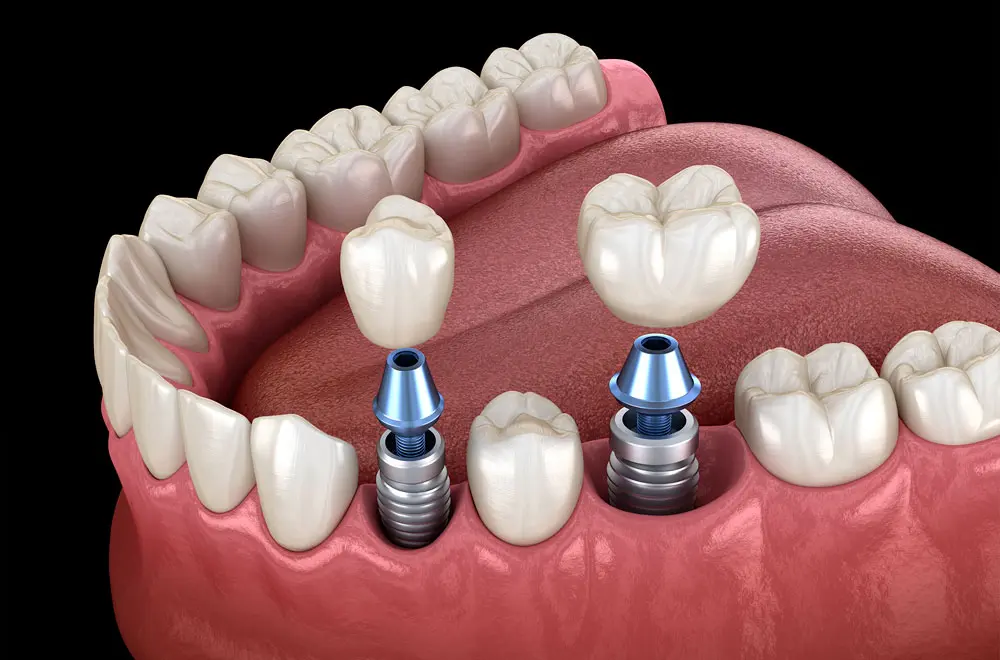 Implants & Prothèses dentaires